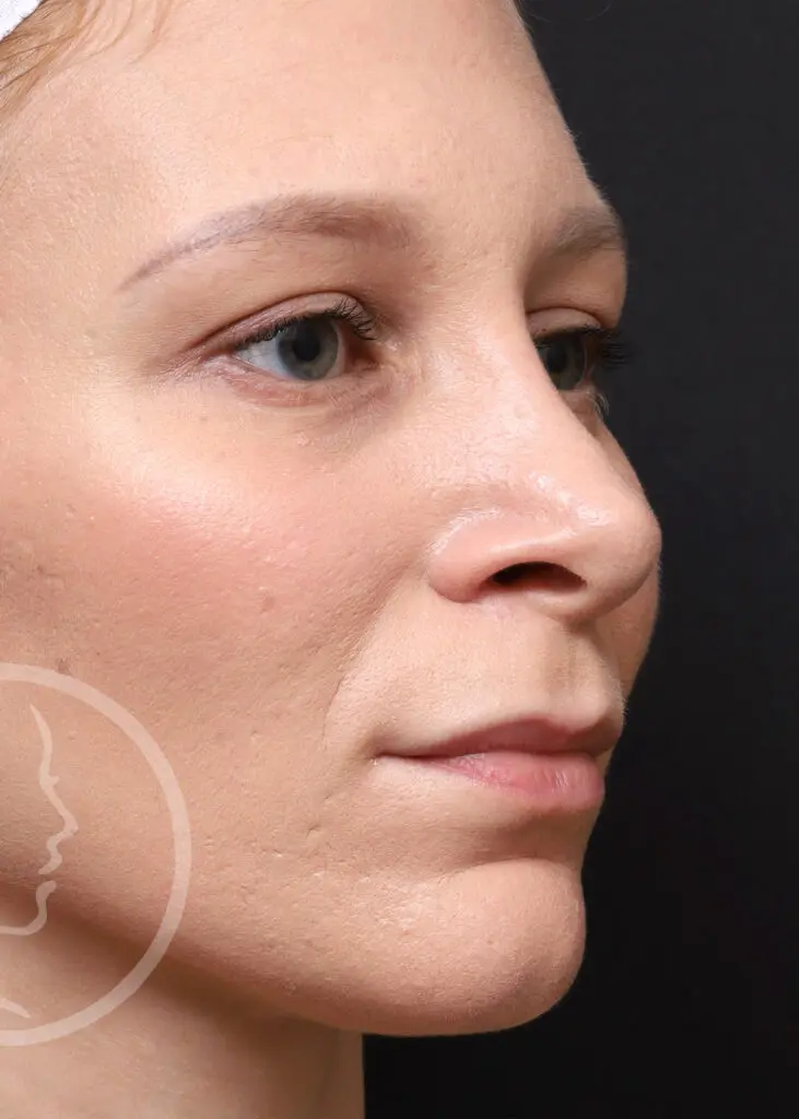 Plastic Surgery Before and After Pictures in Jacksonville, FL - Garcia Facial Plastic Surgery