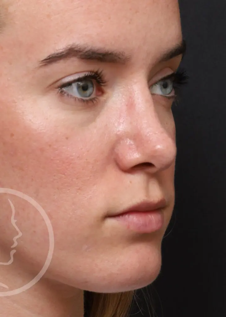 Plastic Surgery Before and After Pictures in Jacksonville, FL - Garcia Facial Plastic Surgery