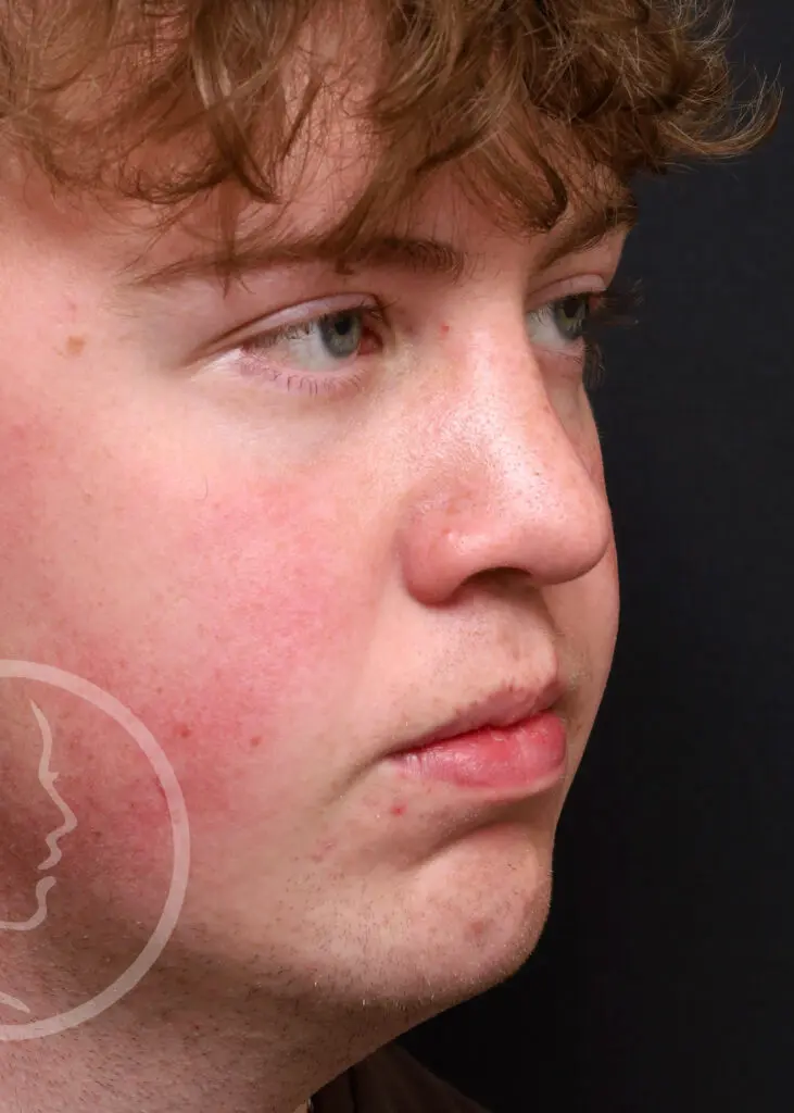 Plastic Surgery Before and After Pictures in Jacksonville, FL - Garcia Facial Plastic Surgery