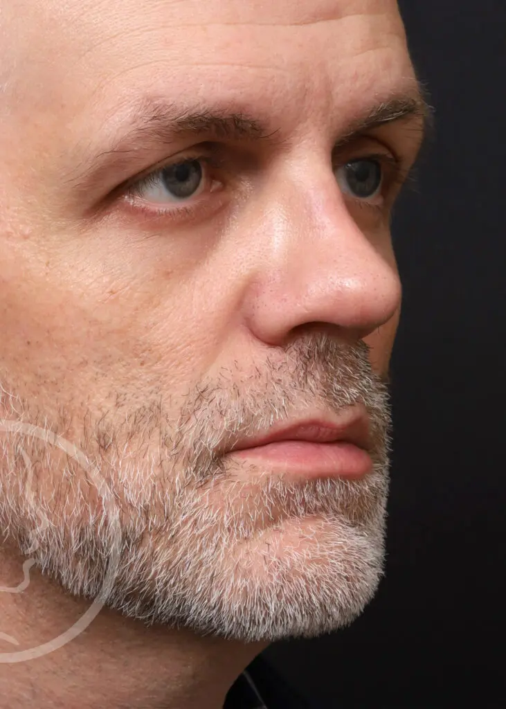 Plastic Surgery Before and After Pictures in Jacksonville, FL - Garcia Facial Plastic Surgery