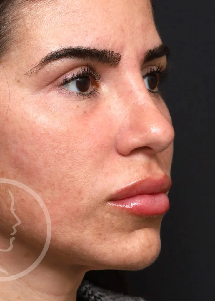 Plastic Surgery Before and After Pictures in Jacksonville, FL - Garcia Facial Plastic Surgery