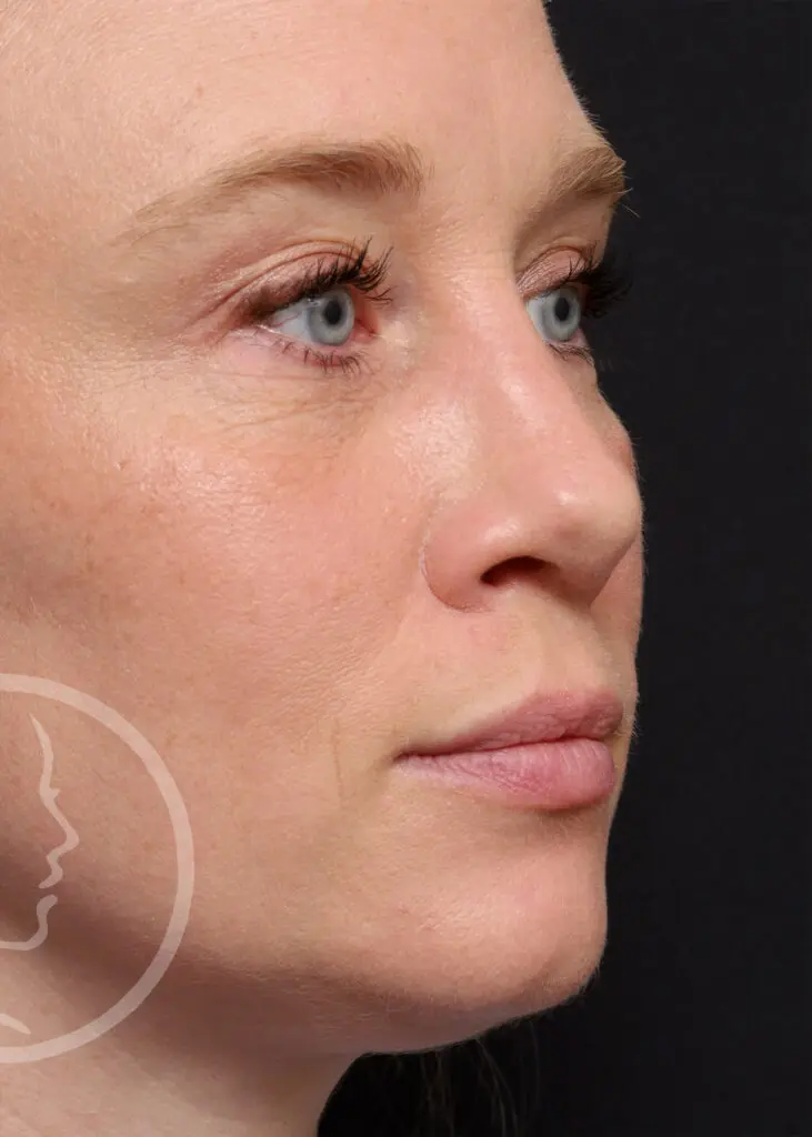 Plastic Surgery Before and After Pictures in Jacksonville, FL - Garcia Facial Plastic Surgery