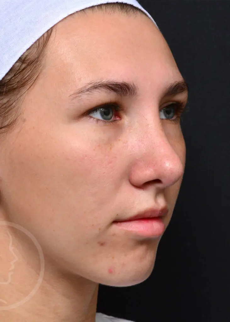 Plastic Surgery Before and After Pictures in Jacksonville, FL - Garcia Facial Plastic Surgery