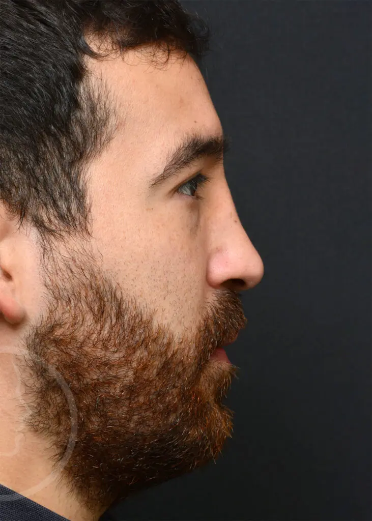 Plastic Surgery Before and After Pictures in Jacksonville, FL - Garcia Facial Plastic Surgery