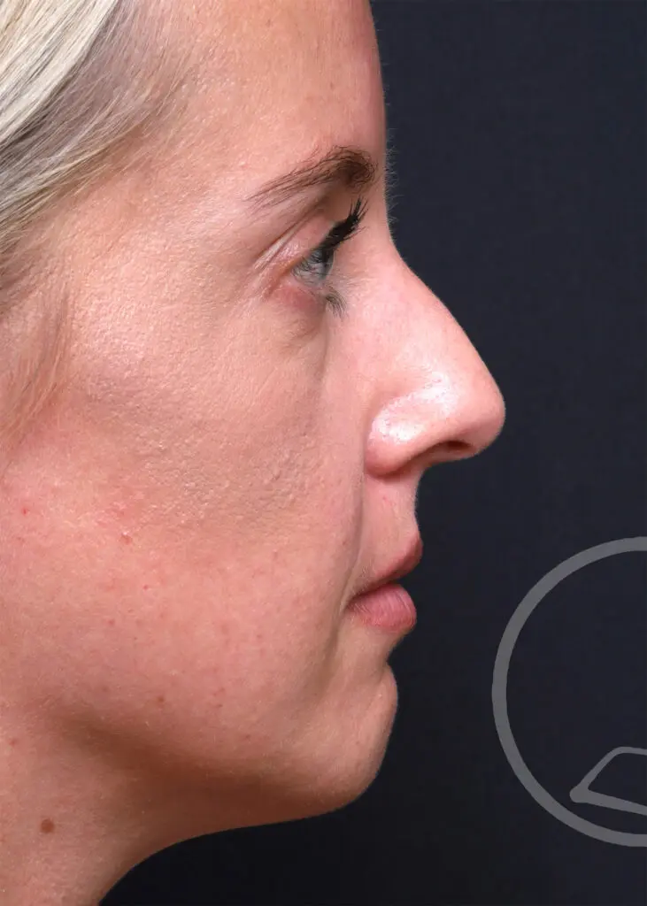 Plastic Surgery Before and After Pictures in Jacksonville, FL - Garcia Facial Plastic Surgery