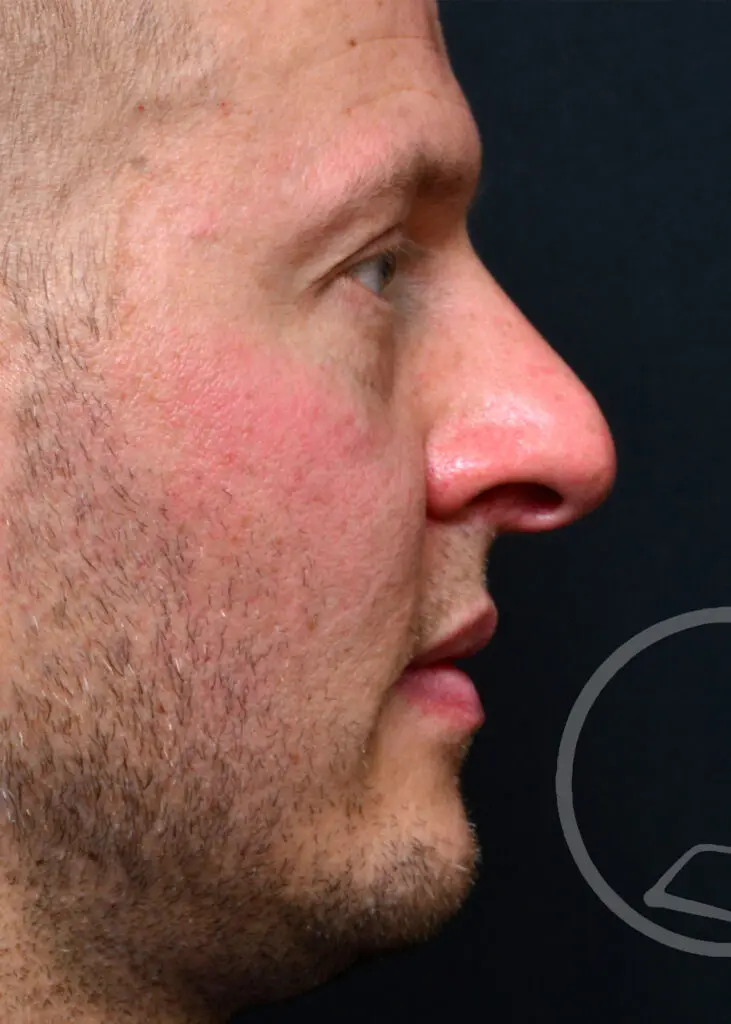 Plastic Surgery Before and After Pictures in Jacksonville, FL - Garcia Facial Plastic Surgery