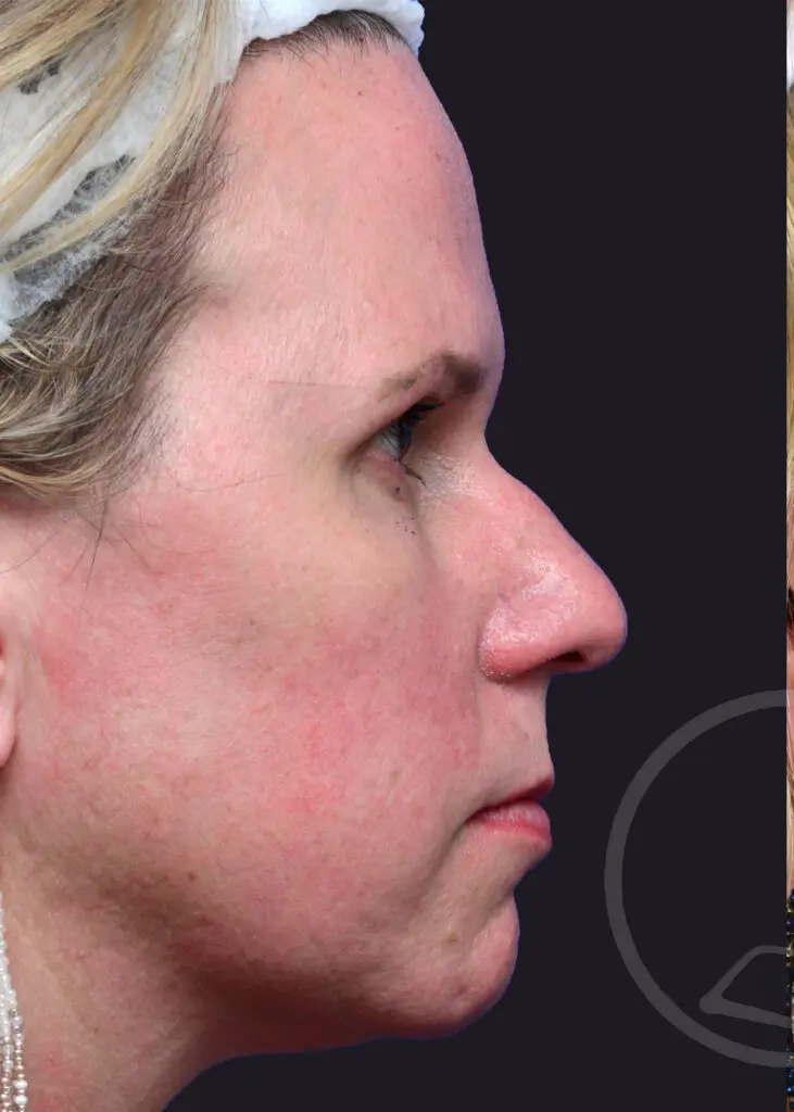 Plastic Surgery Before and After Pictures in Jacksonville, FL - Garcia Facial Plastic Surgery