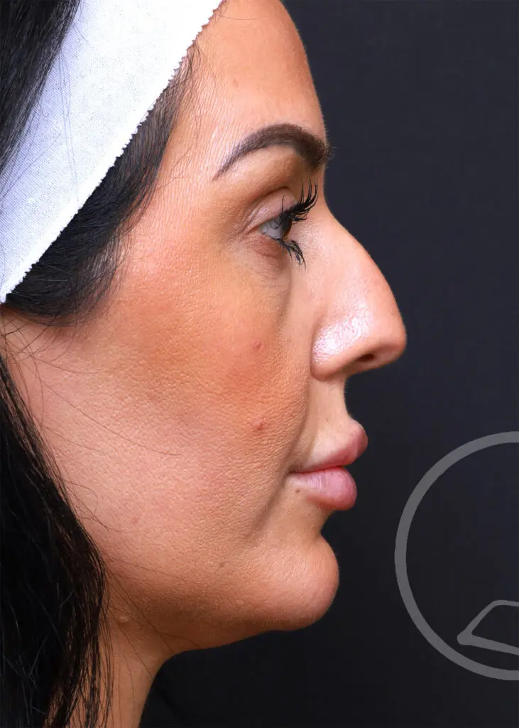 Plastic Surgery Before and After Pictures in Jacksonville, FL - Garcia Facial Plastic Surgery