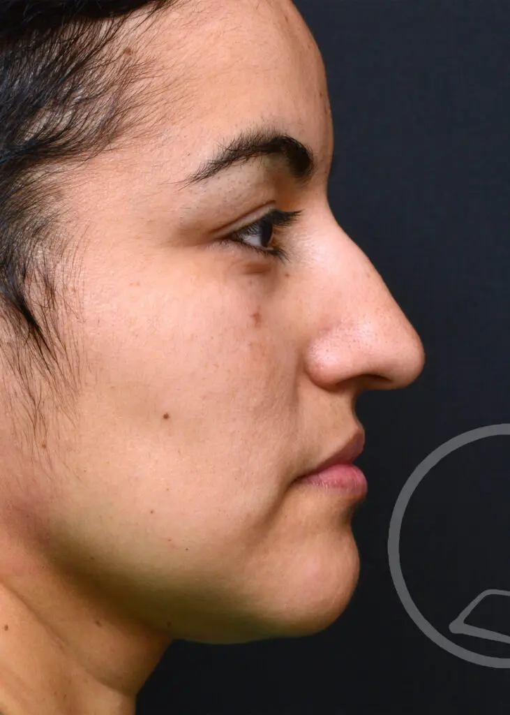 Plastic Surgery Before and After Pictures in Jacksonville, FL - Garcia Facial Plastic Surgery