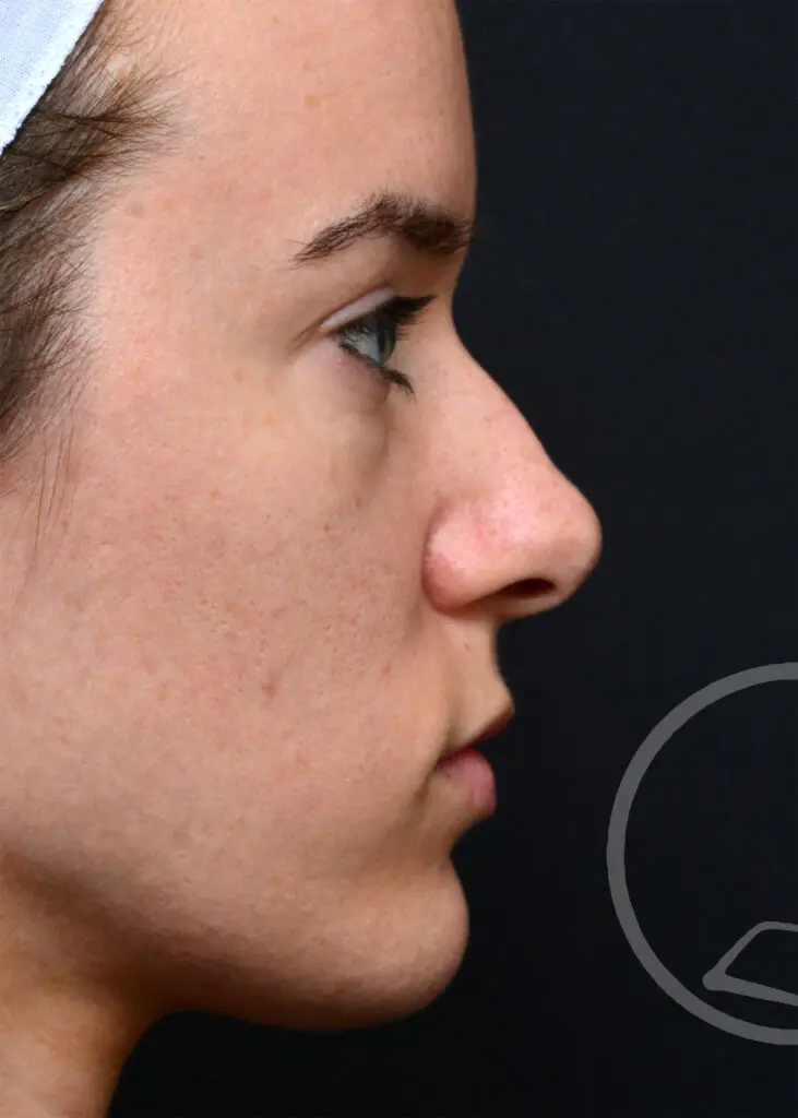 Plastic Surgery Before and After Pictures in Jacksonville, FL - Garcia Facial Plastic Surgery