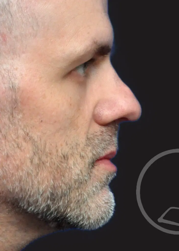 Plastic Surgery Before and After Pictures in Jacksonville, FL - Garcia Facial Plastic Surgery