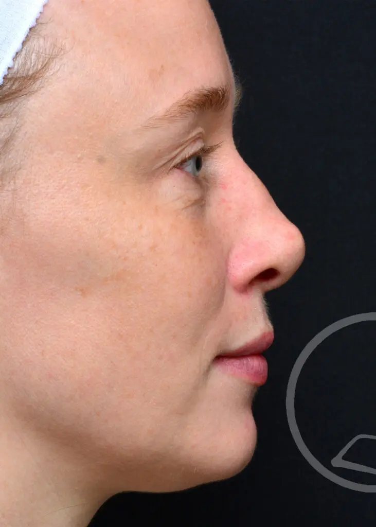 Plastic Surgery Before and After Pictures in Jacksonville, FL - Garcia Facial Plastic Surgery