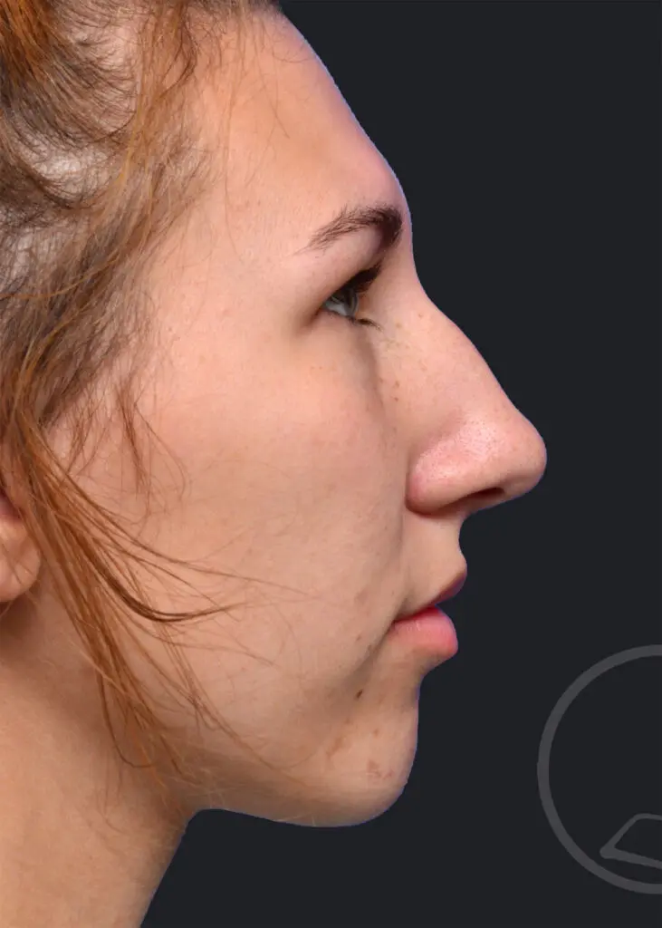 Plastic Surgery Before and After Pictures in Jacksonville, FL - Garcia Facial Plastic Surgery