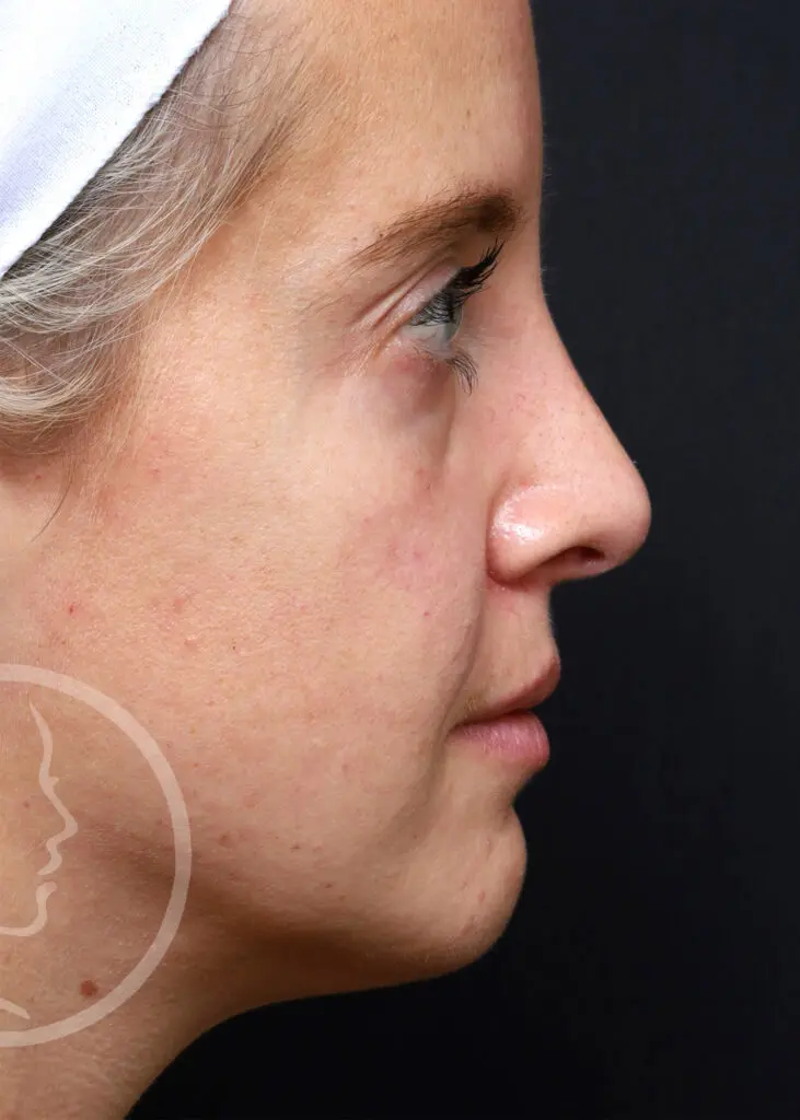 Plastic Surgery Before and After Pictures in Jacksonville, FL - Garcia Facial Plastic Surgery