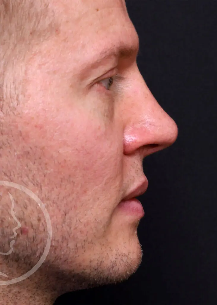 Plastic Surgery Before and After Pictures in Jacksonville, FL - Garcia Facial Plastic Surgery