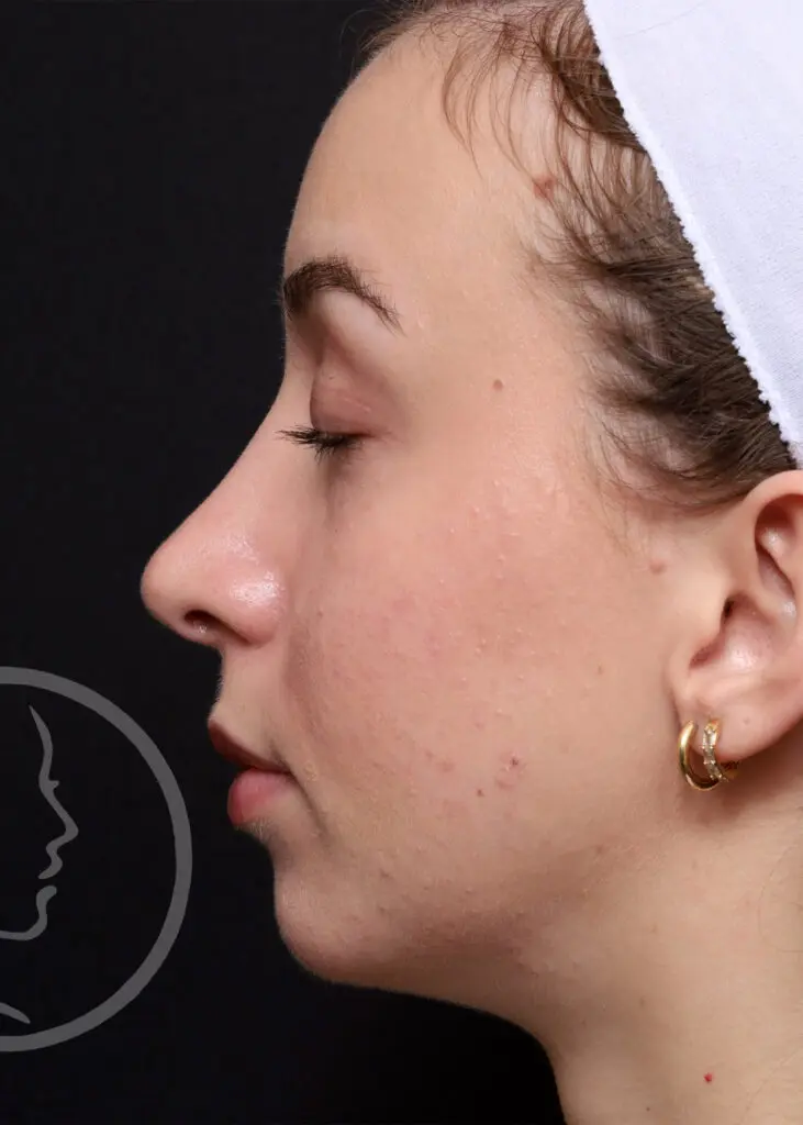 Plastic Surgery Before and After Pictures in Jacksonville, FL - Garcia Facial Plastic Surgery