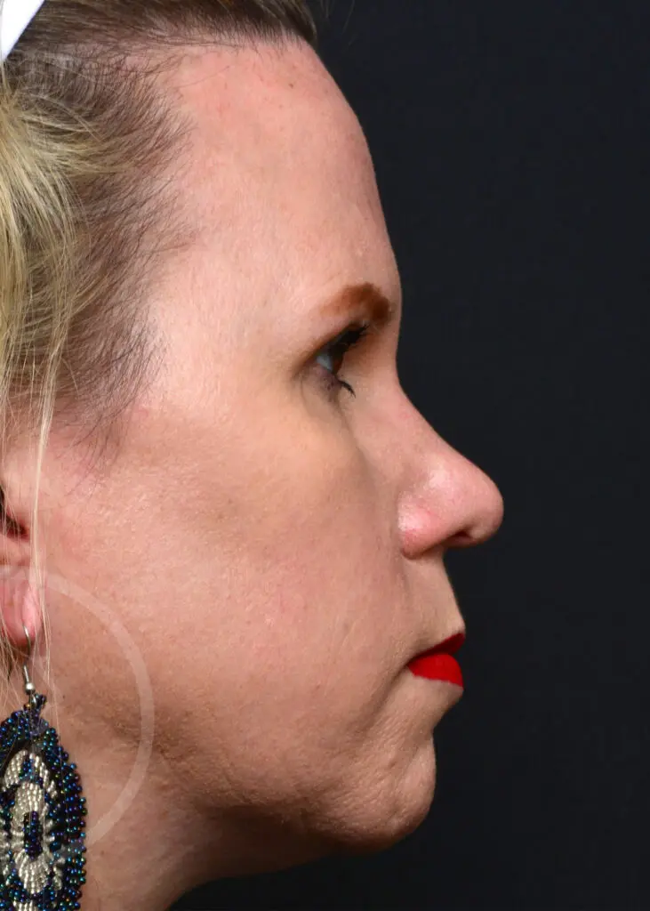 Plastic Surgery Before and After Pictures in Jacksonville, FL - Garcia Facial Plastic Surgery