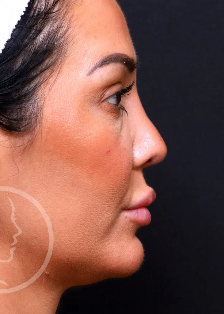 Plastic Surgery Before and After Pictures in Jacksonville, FL - Garcia Facial Plastic Surgery