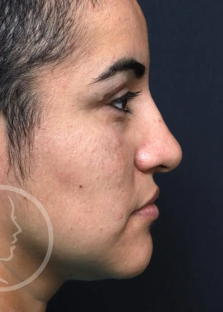 Plastic Surgery Before and After Pictures in Jacksonville, FL - Garcia Facial Plastic Surgery