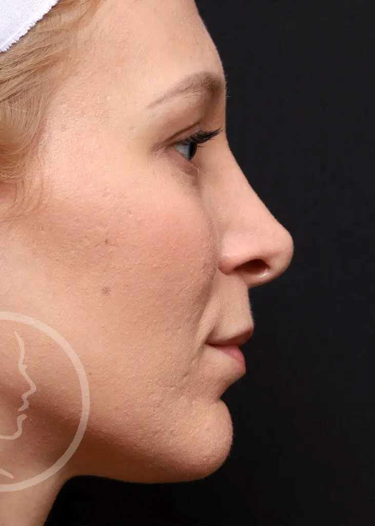 Plastic Surgery Before and After Pictures in Jacksonville, FL - Garcia Facial Plastic Surgery