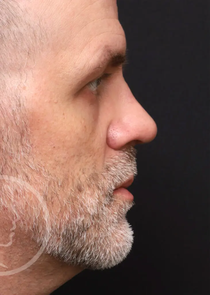 Plastic Surgery Before and After Pictures in Jacksonville, FL - Garcia Facial Plastic Surgery