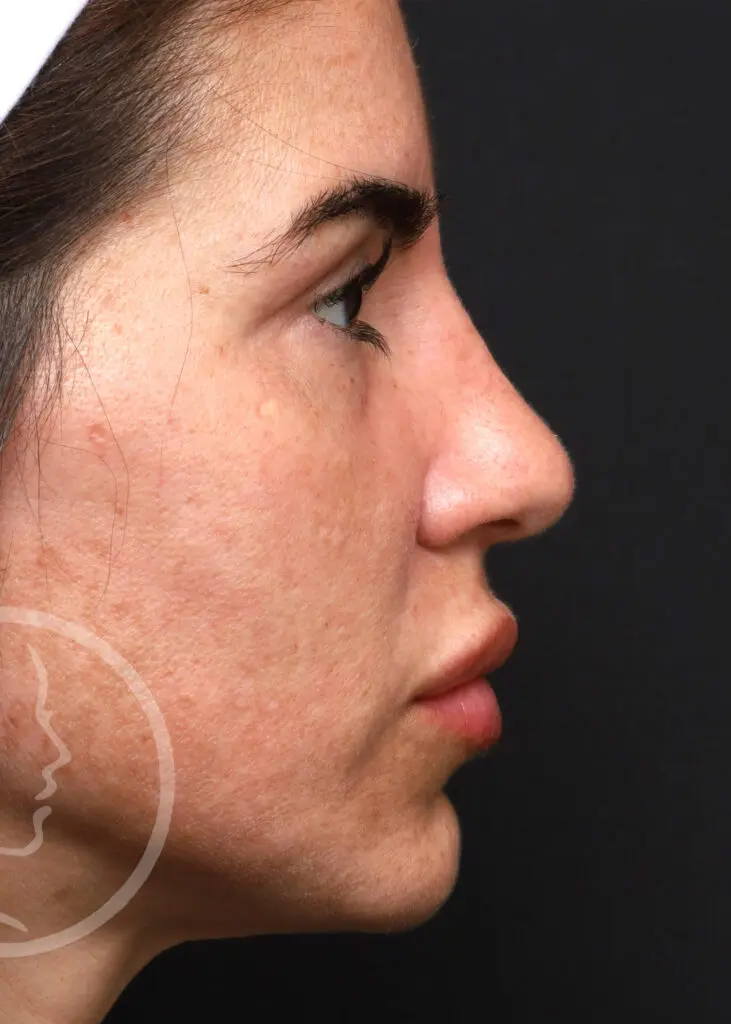 Plastic Surgery Before and After Pictures in Jacksonville, FL - Garcia Facial Plastic Surgery