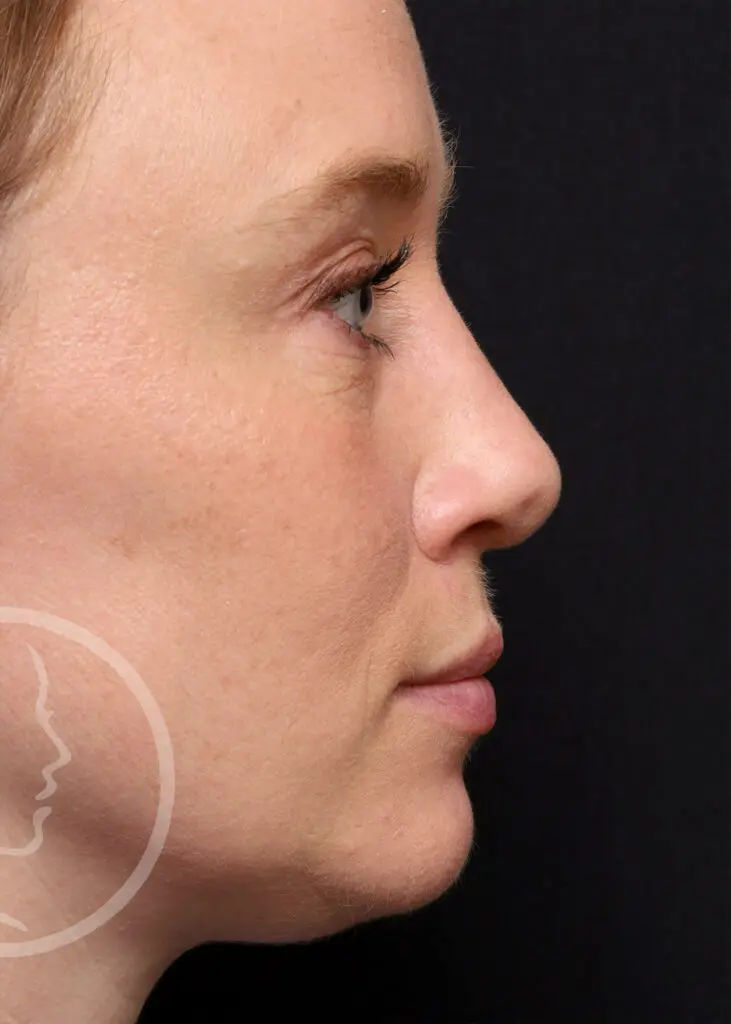Plastic Surgery Before and After Pictures in Jacksonville, FL - Garcia Facial Plastic Surgery