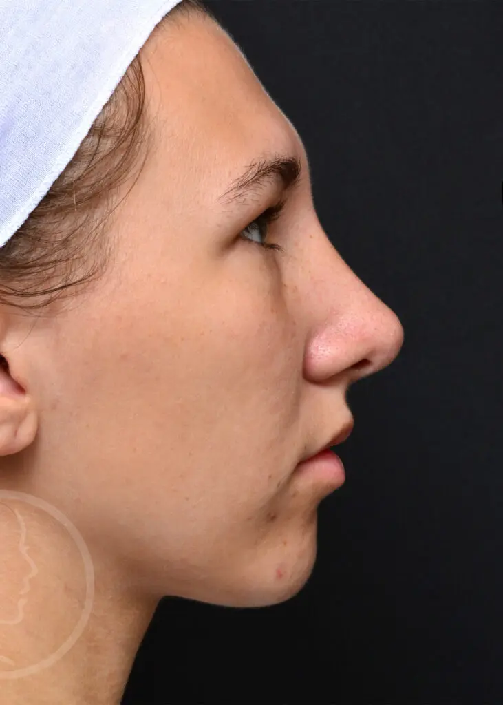 Plastic Surgery Before and After Pictures in Jacksonville, FL - Garcia Facial Plastic Surgery