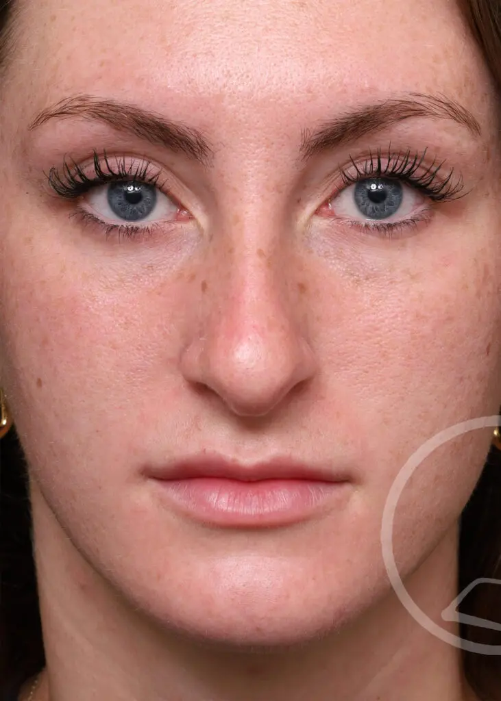 Plastic Surgery Before and After Pictures in Jacksonville, FL - Garcia Facial Plastic Surgery