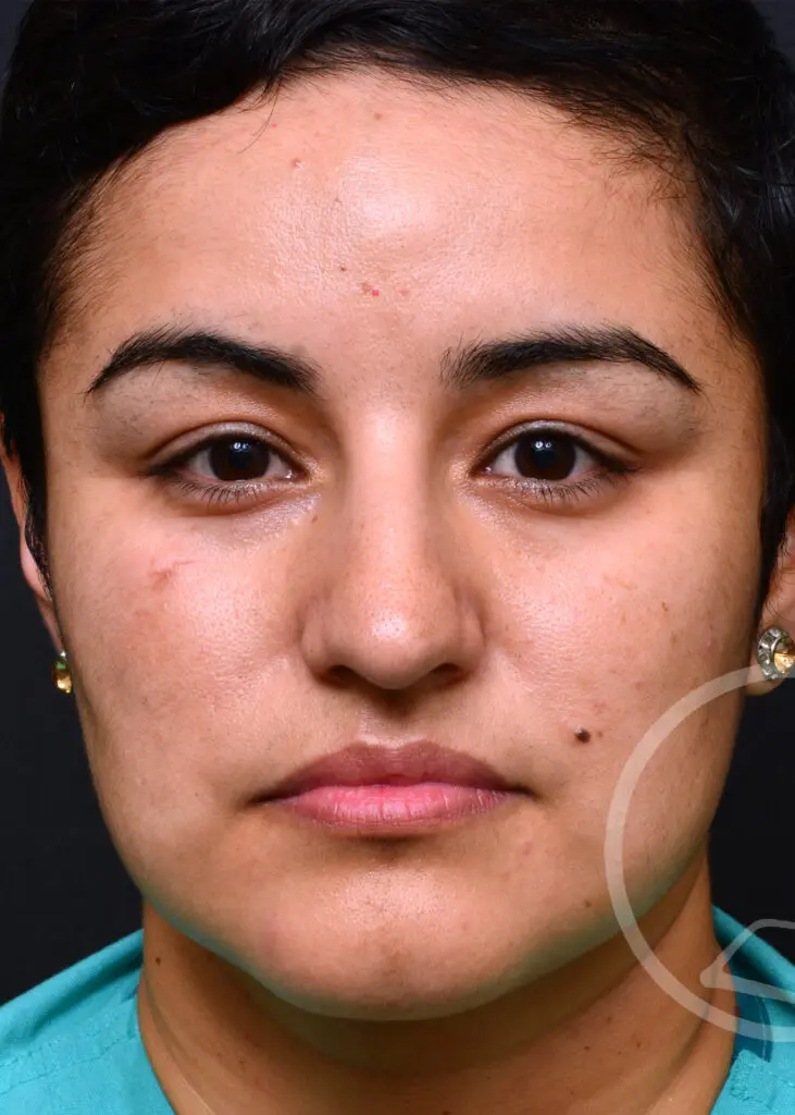 Plastic Surgery Before and After Pictures in Jacksonville, FL - Garcia Facial Plastic Surgery