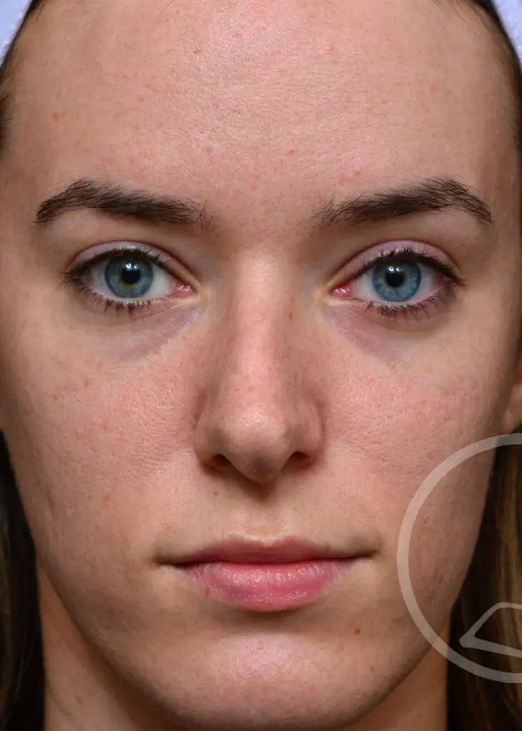 Plastic Surgery Before and After Pictures in Jacksonville, FL - Garcia Facial Plastic Surgery