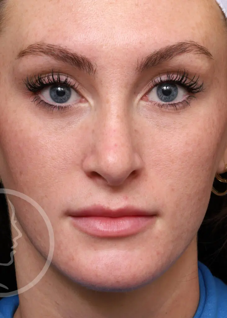 Plastic Surgery Before and After Pictures in Jacksonville, FL - Garcia Facial Plastic Surgery