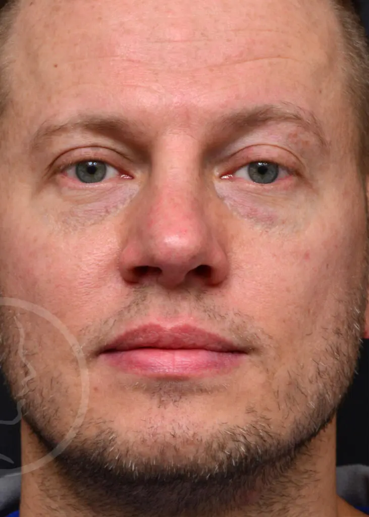 Plastic Surgery Before and After Pictures in Jacksonville, FL - Garcia Facial Plastic Surgery