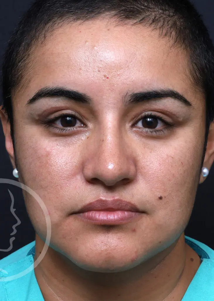 Plastic Surgery Before and After Pictures in Jacksonville, FL - Garcia Facial Plastic Surgery