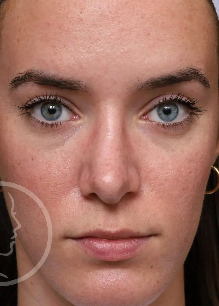 Plastic Surgery Before and After Pictures in Jacksonville, FL - Garcia Facial Plastic Surgery