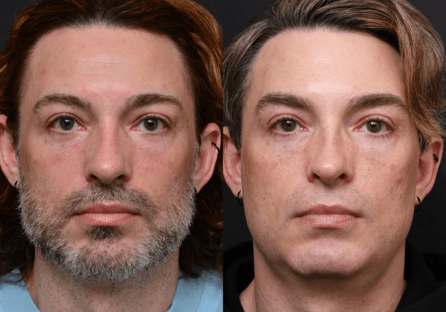 Mens Botox Before and After