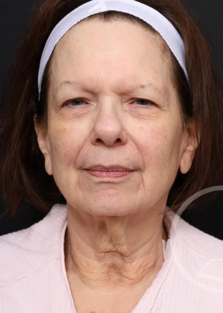 Plastic Surgery Before and After Pictures in Jacksonville, FL - Garcia Facial Plastic Surgery