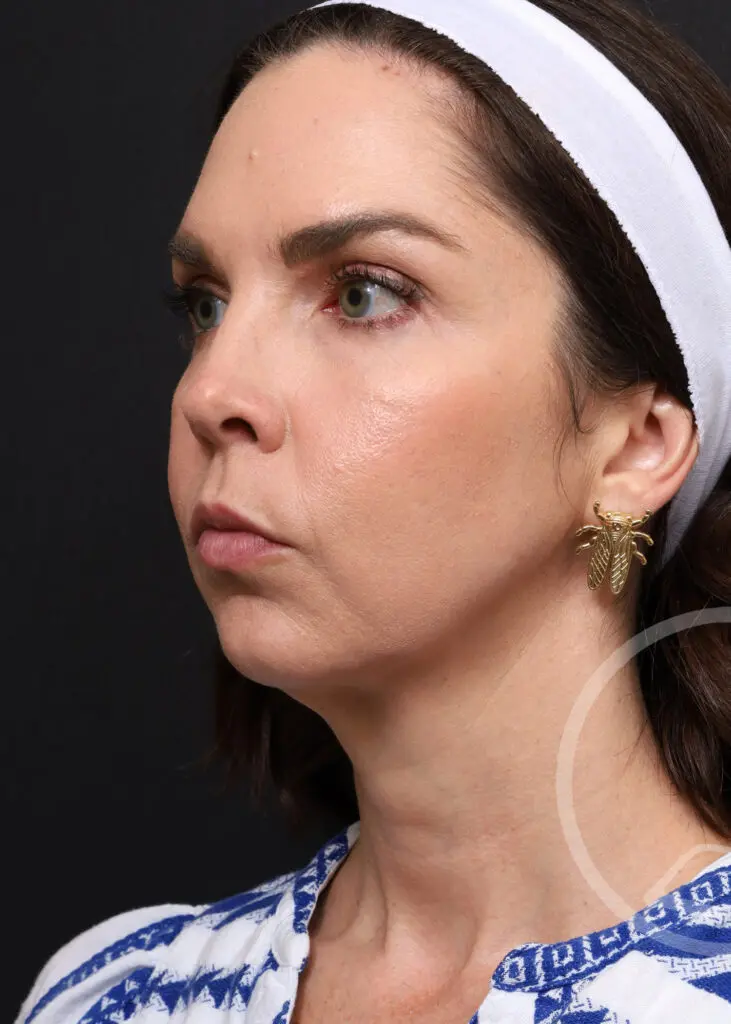 Plastic Surgery Before and After Pictures in Jacksonville, FL - Garcia Facial Plastic Surgery