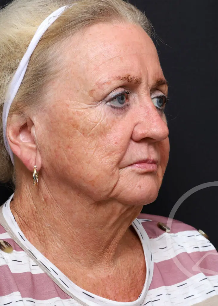 Plastic Surgery Before and After Pictures in Jacksonville, FL - Garcia Facial Plastic Surgery