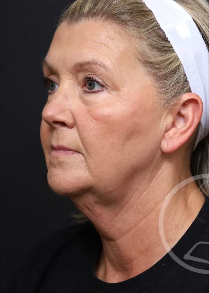 Plastic Surgery Before and After Pictures in Jacksonville, FL - Garcia Facial Plastic Surgery