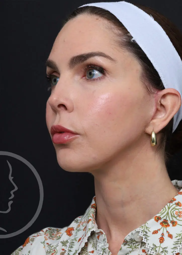 Plastic Surgery Before and After Pictures in Jacksonville, FL - Garcia Facial Plastic Surgery