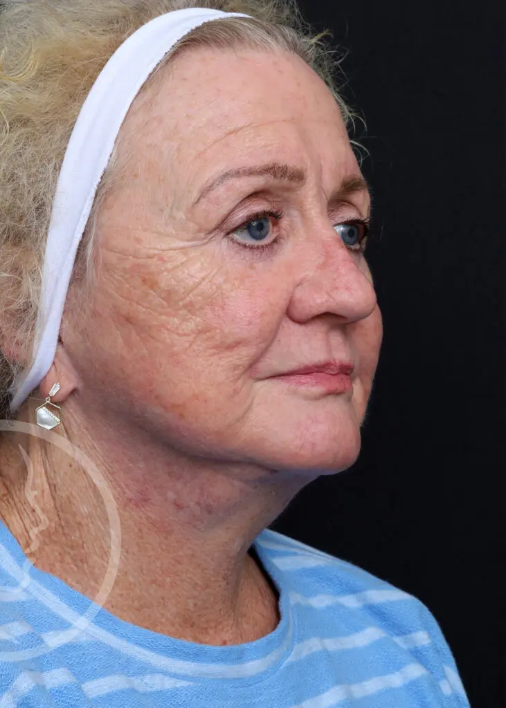 Plastic Surgery Before and After Pictures in Jacksonville, FL - Garcia Facial Plastic Surgery