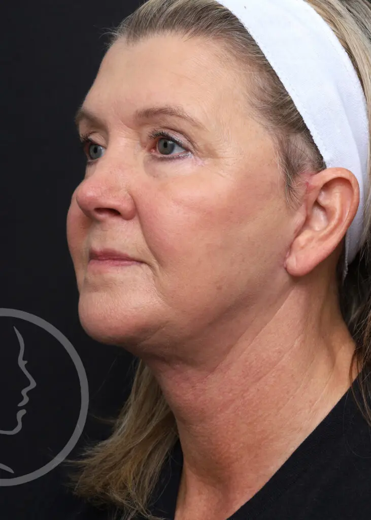Plastic Surgery Before and After Pictures in Jacksonville, FL - Garcia Facial Plastic Surgery