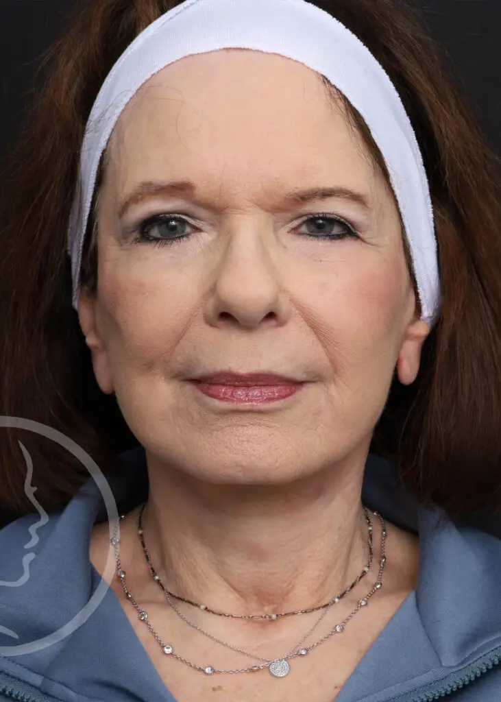 Plastic Surgery Before and After Pictures in Jacksonville, FL - Garcia Facial Plastic Surgery