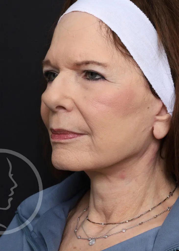Plastic Surgery Before and After Pictures in Jacksonville, FL - Garcia Facial Plastic Surgery