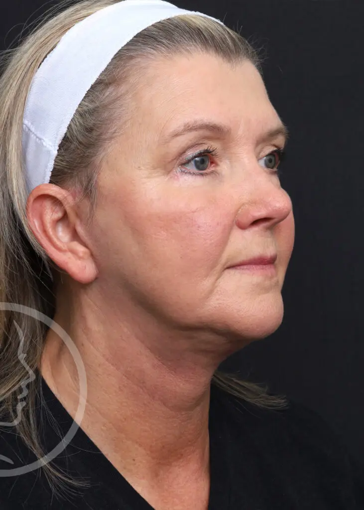 Plastic Surgery Before and After Pictures in Jacksonville, FL - Garcia Facial Plastic Surgery