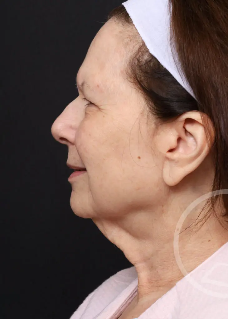 Plastic Surgery Before and After Pictures in Jacksonville, FL - Garcia Facial Plastic Surgery