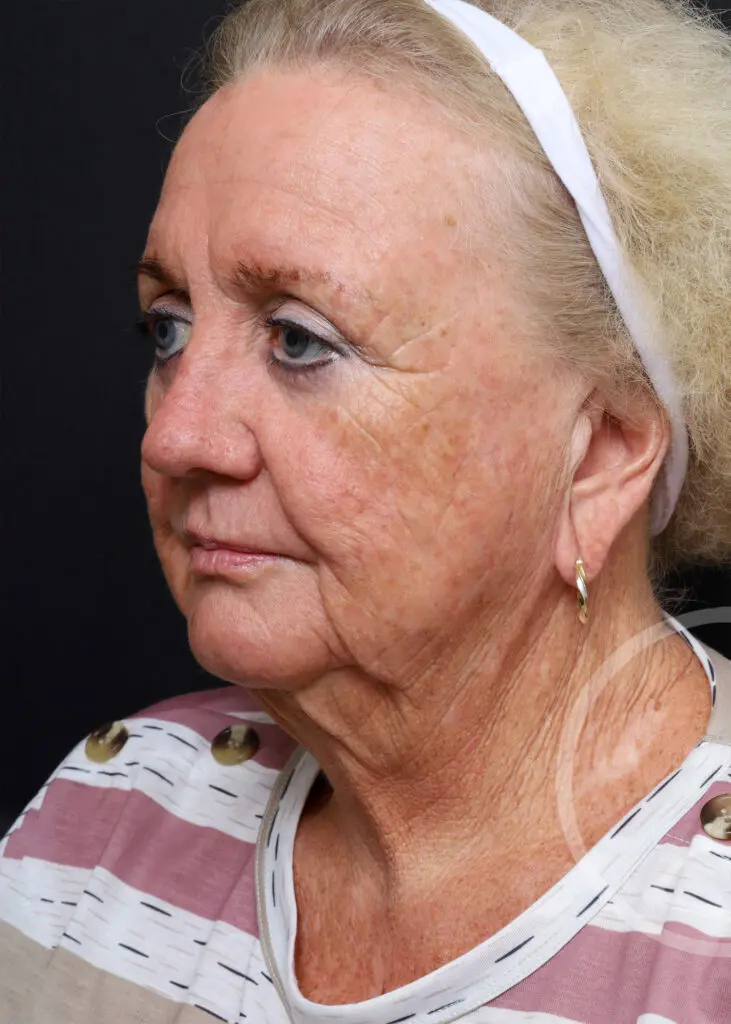 Plastic Surgery Before and After Pictures in Jacksonville, FL - Garcia Facial Plastic Surgery