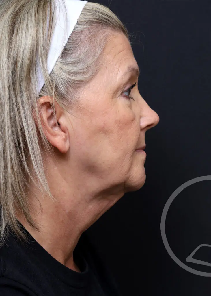 Plastic Surgery Before and After Pictures in Jacksonville, FL - Garcia Facial Plastic Surgery