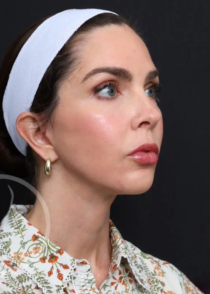 Plastic Surgery Before and After Pictures in Jacksonville, FL - Garcia Facial Plastic Surgery